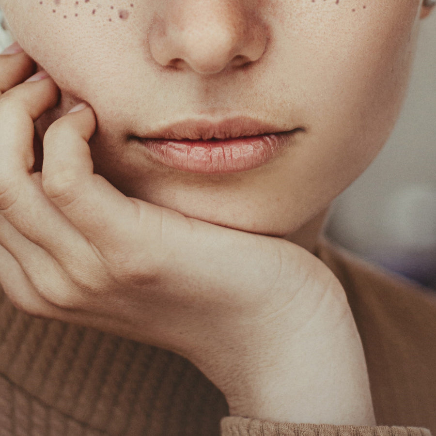 How to Get Rid of Acne Around Mouth?