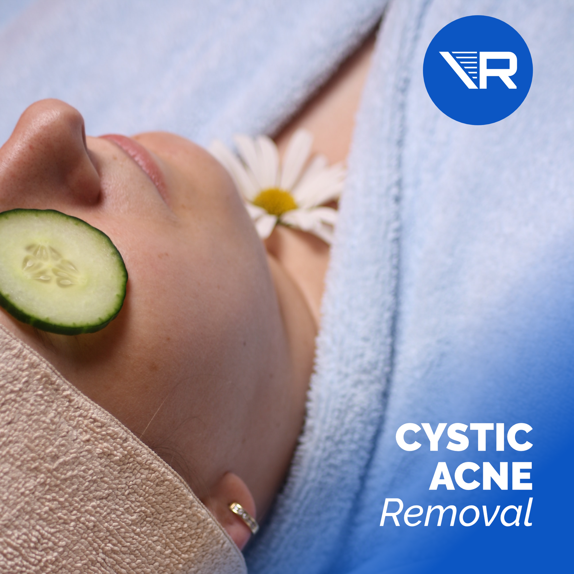 Cystic Acne Removal