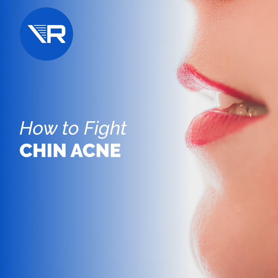 What's the Deal with Chin Acne?