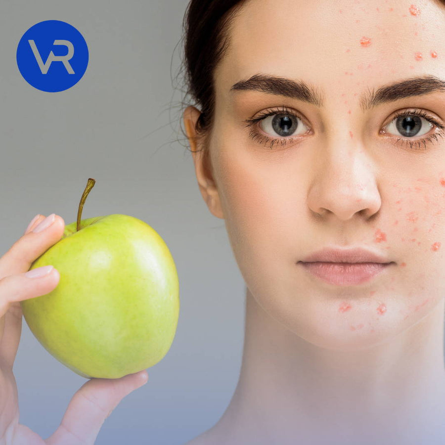 Сystic Acne Diet: What Foods Cause Cysts & How to Clear Them