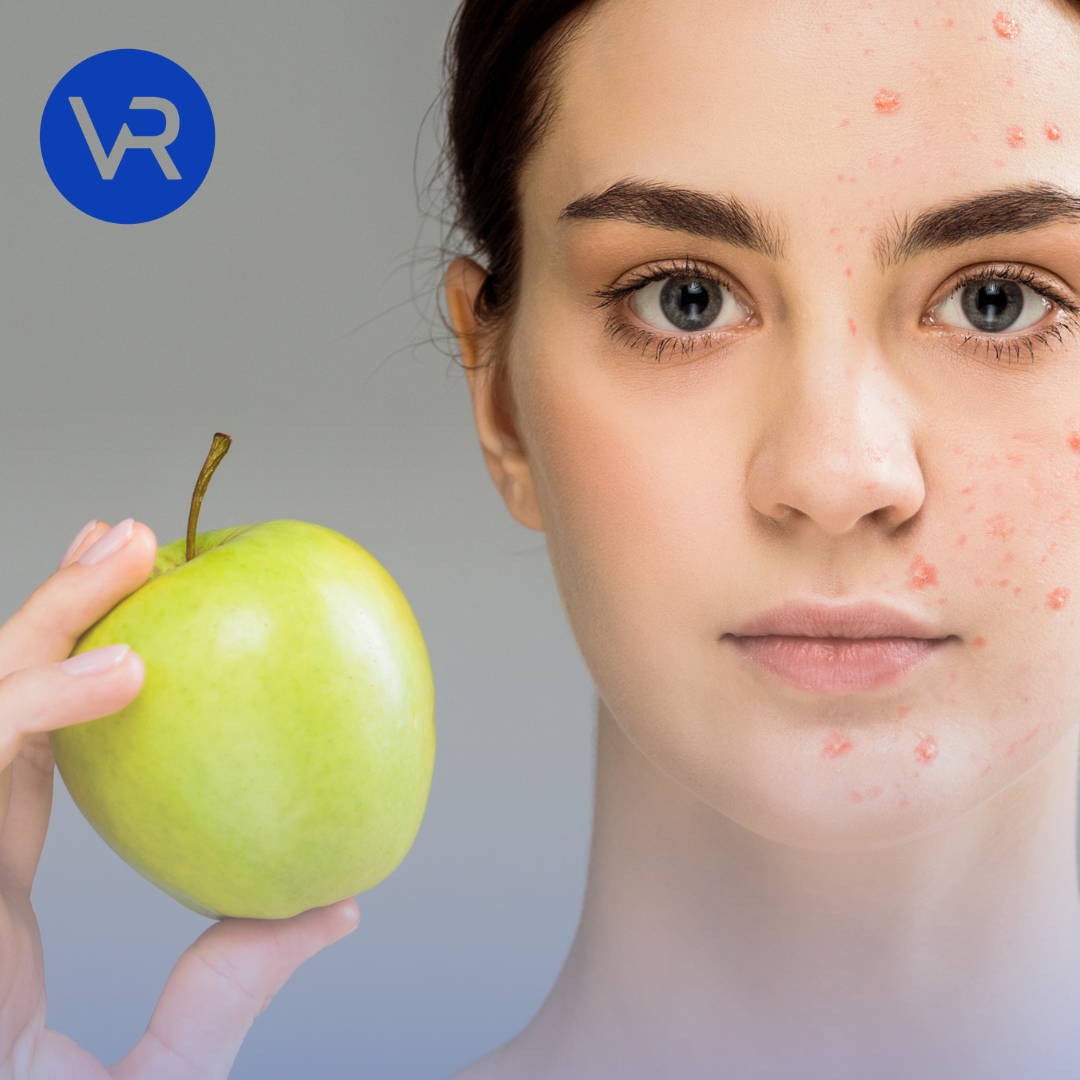 Сystic Acne Diet: What Foods Cause Cysts & How to Clear Them