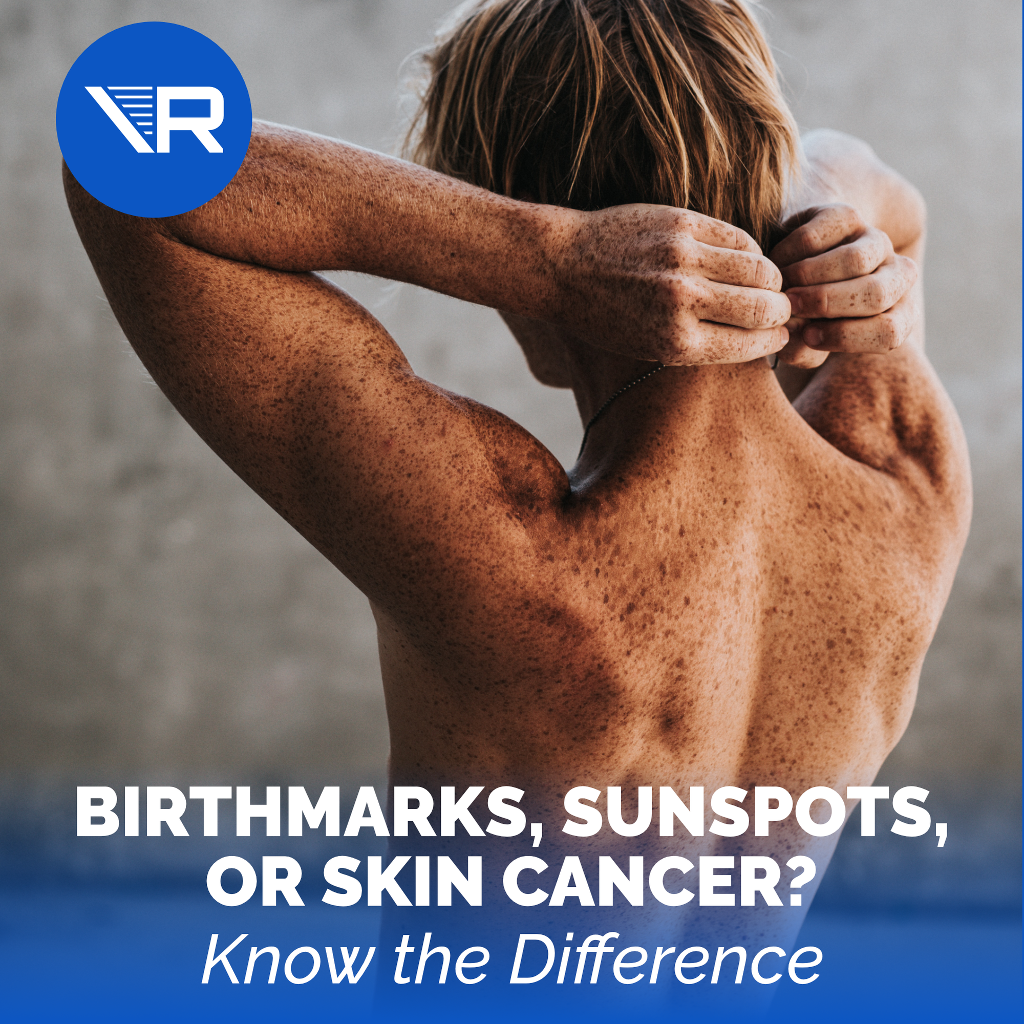 Birthmarks, Skin Cancer, or Sunspots on Skin? Know the Difference